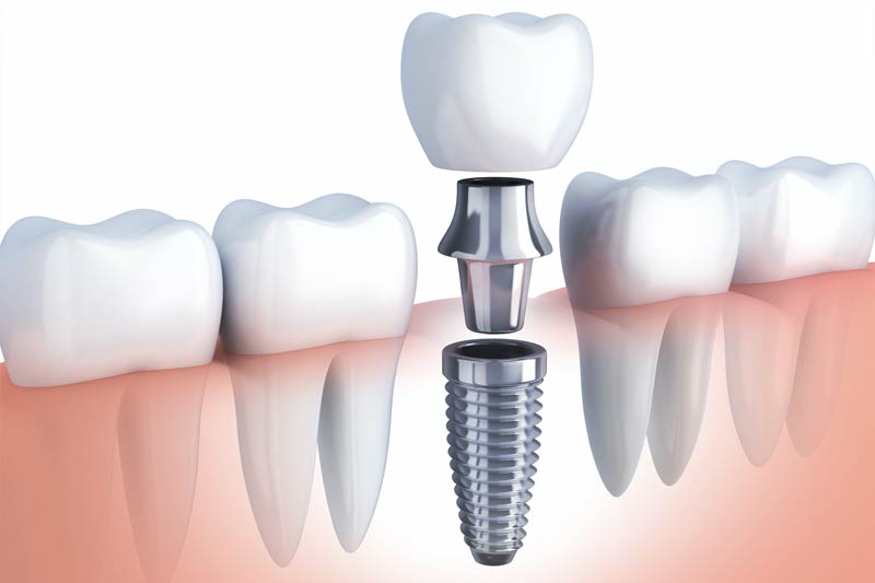 Implants Dentist in Holladay